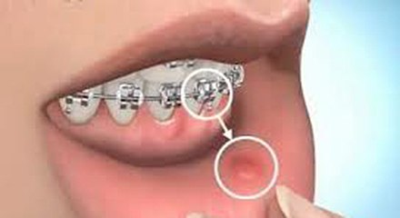 روش ساده حل کردن موقت مشکل تیزی سیم ارتودنسی و شکستن براکت